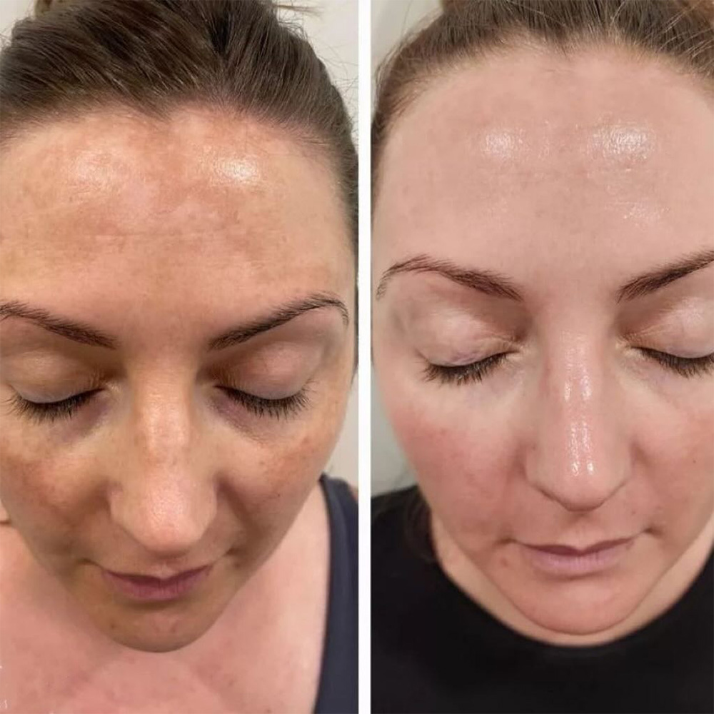 Lazer peeling natijasi